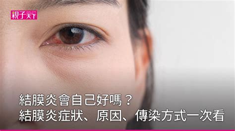 眼睛周圍紅腫|急性結膜炎原因？會傳染嗎？症狀、治療方式一次看